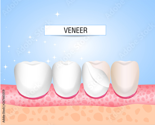 Veneers, Lumineers, onlays, microprosthesis. Installation of veneers. Aesthetic medicine. Direction dentistry orthopedics