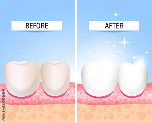 The concept of healthy and diseased tooth. Visual aid for students, dentists, patients of the clinic. Defeat caries, the focus of destruction in the teeth. Vector illustration
