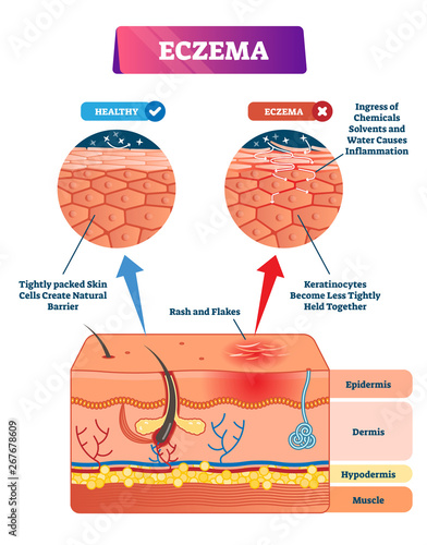 Eczema vector illustration. Labeled anatomical structure comparative scheme photo