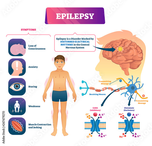 Epilepsy vector illustration. Labeled sick CNS disorder educational scheme. photo