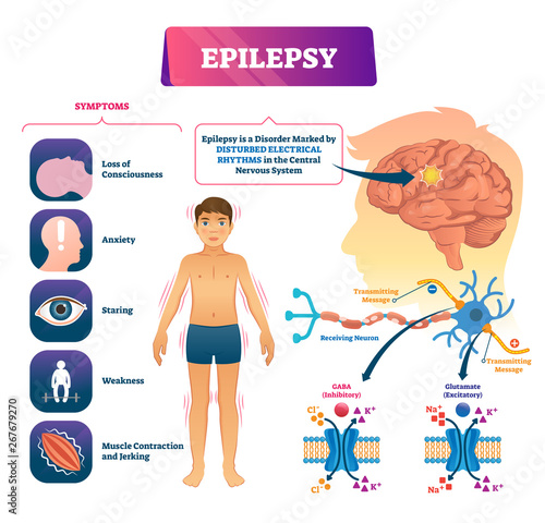 Epilepsy vector illustration. Labeled sick CNS disorder educational scheme.