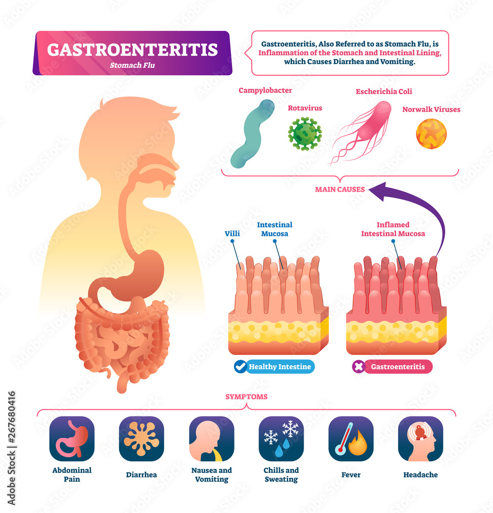 Gastroenteritis Vector Illustration Labeled Stomach Inflammation 