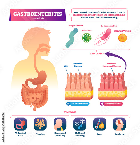 Gastroenteritis vector illustration. Labeled stomach inflammation scheme