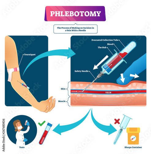 Phlebotomy vector illustration. Labeled veins blood samples process scheme.