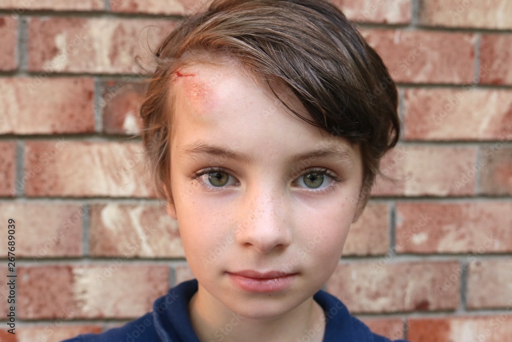 Closeup of the face of a short haired child with big green eyes and a big bruise and cut on the forehead Closeup of the face of a short haired child with big green eyes and a big bruise and cut on the forehead