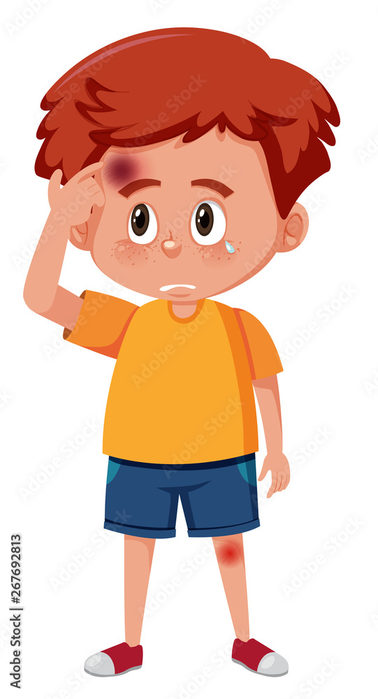 A boy having bruise on head