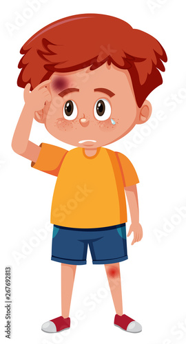 A boy having bruise on head