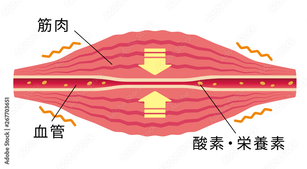 こわばった筋肉により圧迫された血管/ 肩こり・凝り・痛みの発生イラスト Stock Vector | Adobe Stock