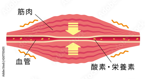 こわばった筋肉により圧迫された血管/ 肩こり・凝り・痛みの発生イラスト