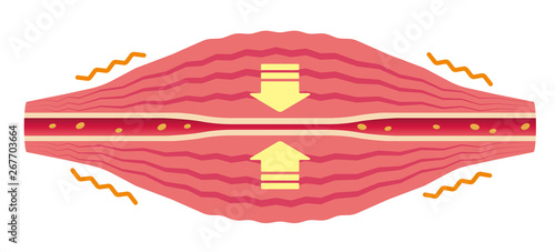 Blood vessel compressed (No text) . Flat illustration of muscle and vessel. 