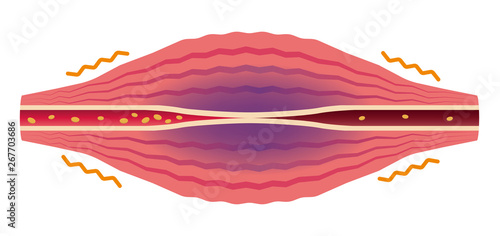 Blood flow worse (No text) . Flat illustration of muscle and vessel. 