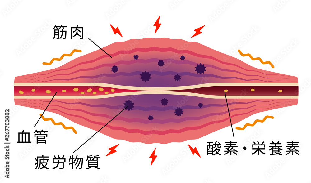 凝り・痛みが発生した筋肉(英語) / 肩こり・凝り・痛みの発生イラスト Stock Vector | Adobe Stock