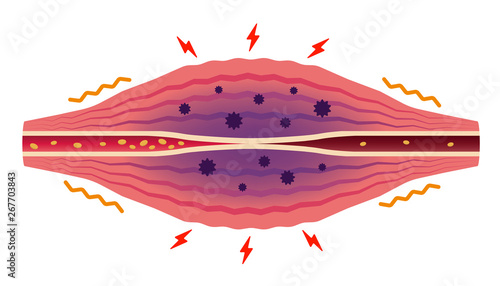 Stuffness and pain occur (No text) . Flat illustration of muscle and vessel.