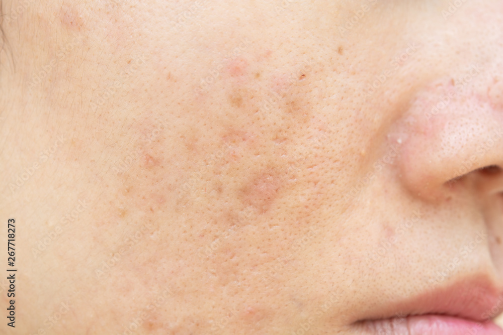 Acne scars and pores. Dark spots. Wrinkles and skin problems Acne scars and pores. Dark spots. Wrinkles and skin problems