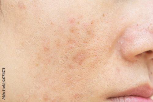 Acne scars and pores. Dark spots. Wrinkles and skin problems