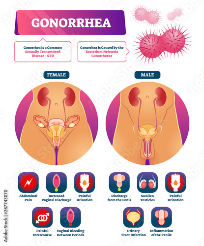 Gonorrhea vector illustration. Labeled STD disease explanation symptom list