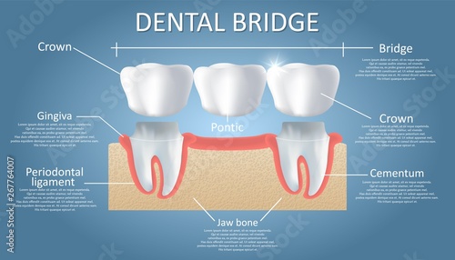 Dental bridge concept vector educational poster, diagram