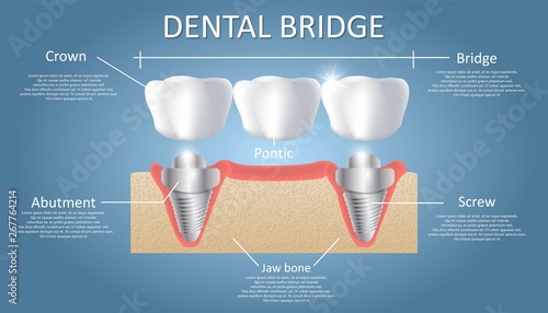 Dental bridge concept vector educational poster, diagram