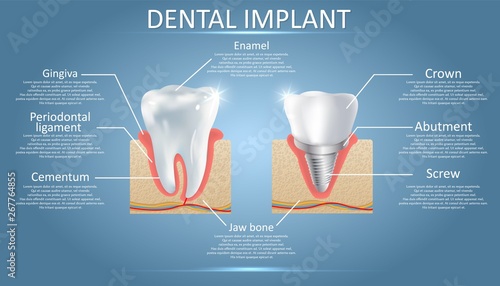Human tooth and dental implant, vector educational poster