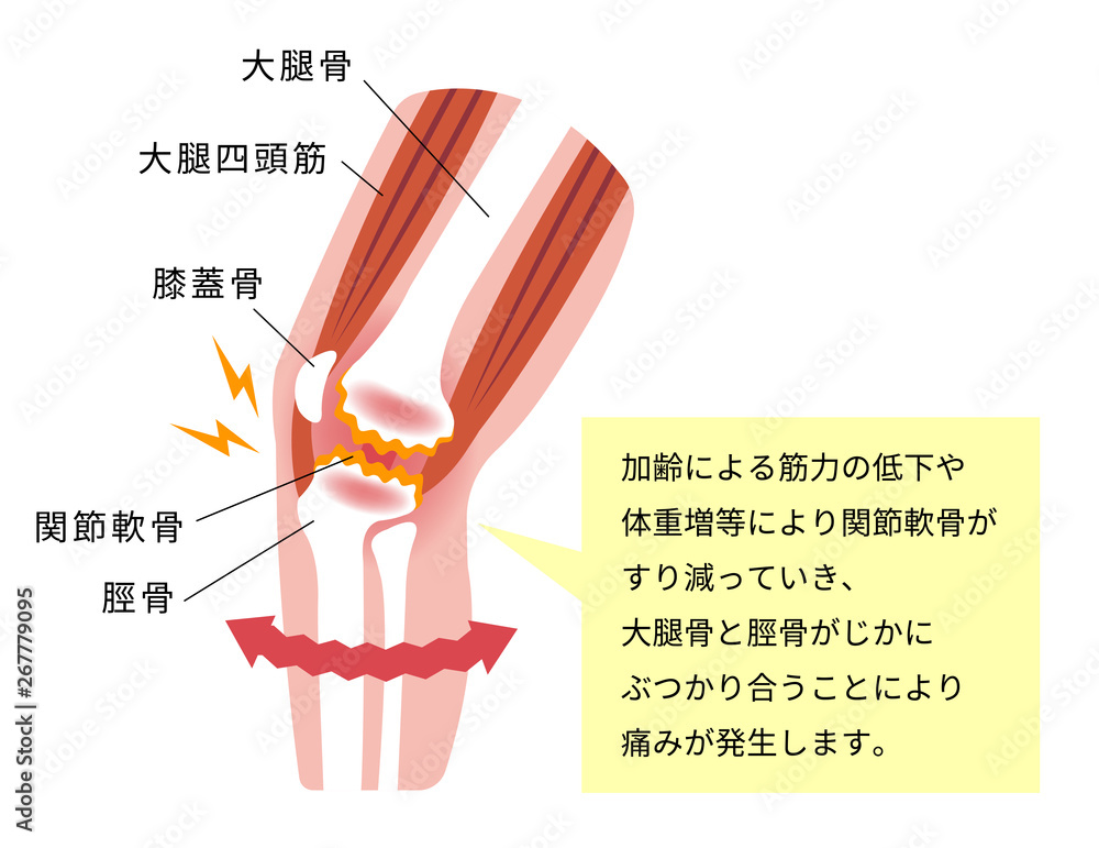 膝の関節痛 変形性膝関節症 発生の仕組みと原因 イラスト Stock Vector Adobe Stock