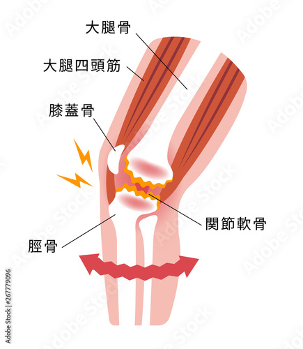 膝の関節痛（変形性膝関節症） 発生の仕組みと原因 イラスト