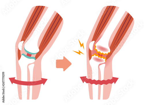 Mechanism and causes of knee joint pain (gonarthrosis / osteoarthritis / arthrosis of knee ) . flat illustration ( no text)