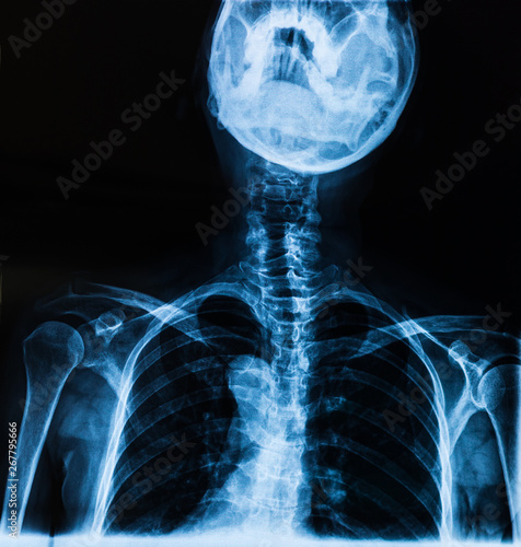 Cervical X-ray film