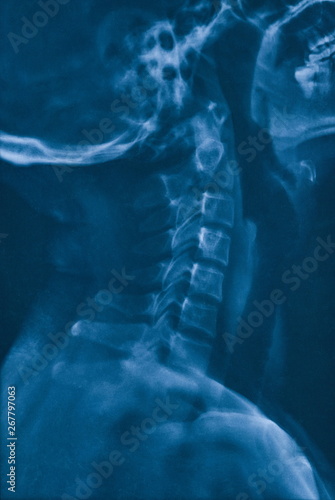 Cervical X-ray film