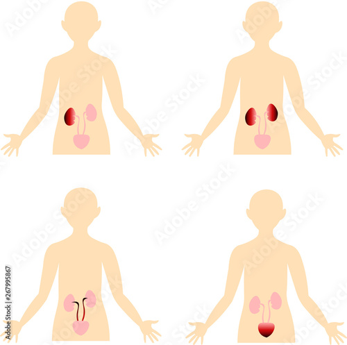 Diseases of the urinary system. Scheme of the human body. Anatomical image. Inflammation, infection.