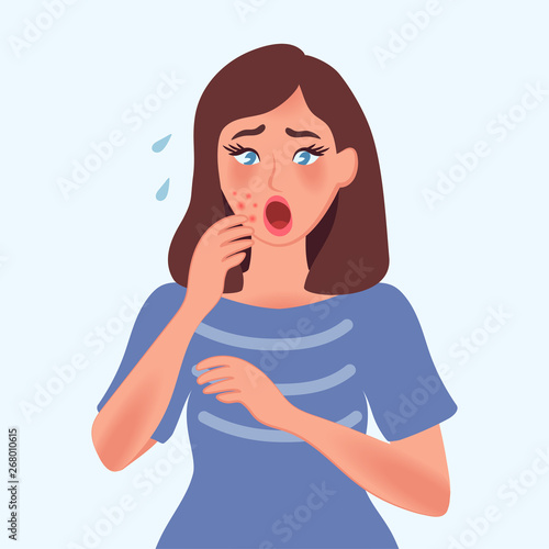 Image of a girl with acne and rashes on her face