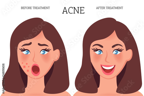 The concept of acne on the skin before and after treatment
