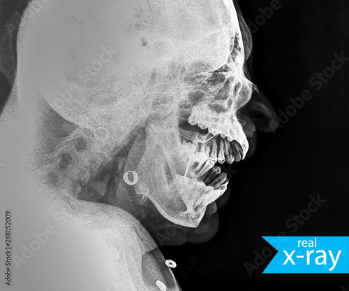 X-ray. A picture of a woman's skull. A real X-ray, medical background. Teeth, spine, neck, skull, cartilage, nose. Turquoise, blue, indigo.