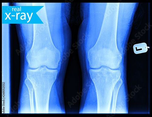 The x-ray of a person's legs. Roentgen of the knee joint. A picture of a skeleton. A real X-ray, medical background. Medicine.