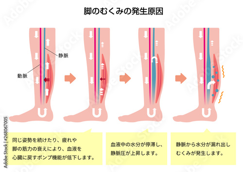 脚のむくみ（浮腫）の発生原因・過程　イラスト photo