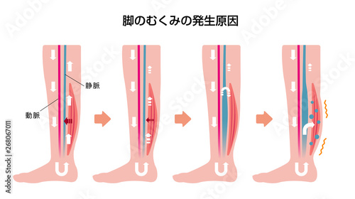 脚のむくみ（浮腫）の発生原因・過程　イラスト photo