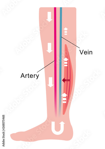 Cause of swelling(edema) of the legs. Decreased blood flow due to muscle weakness. flat illustration.
