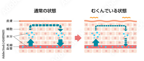 皮膚断面図イラスト / むくみ（浮腫）の発生した皮膚と通常の皮膚 比較図