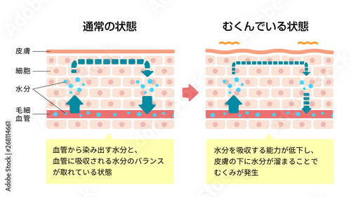 皮膚断面図イラスト / むくみ（浮腫）の発生した皮膚と通常の皮膚 比較図（解説文付き）