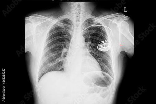 Xray film of a patient with cardiac pace macker
