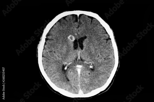 CT scan of a patient with brain abscess