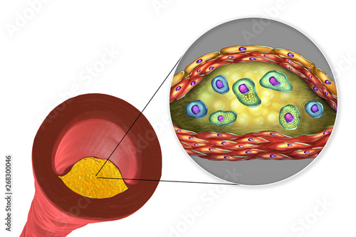 Structure of atherosclerotic plaque. Illustration showing necrotic center, foam cells, T-lymphocytes inside of cholesterol plaque with walls made of smooth muscle cells and endothelium of blood vessel photo