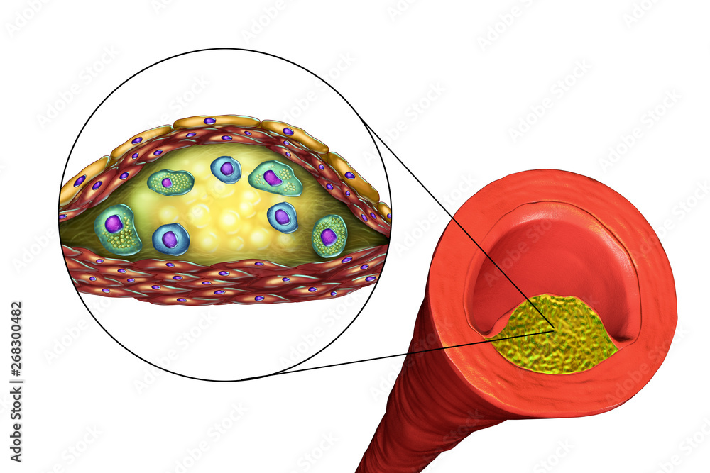 Structure of atherosclerotic plaque. Illustration showing necrotic center, foam cells, T