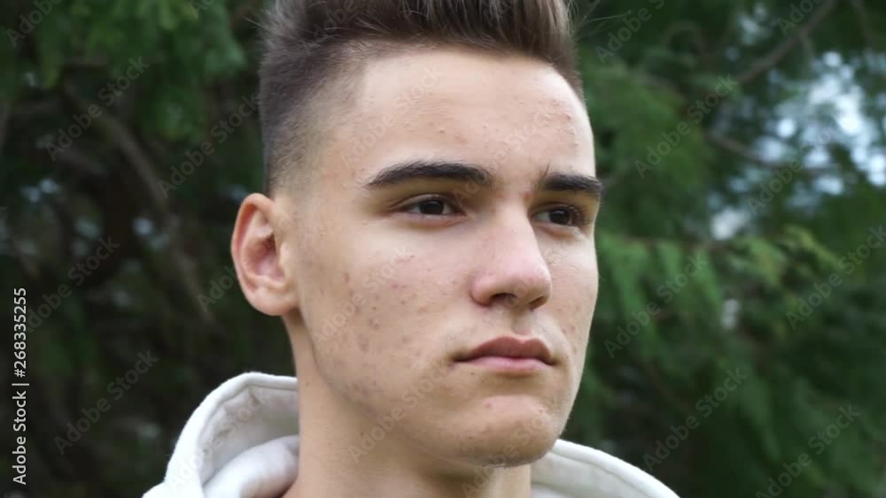 The face with pimples and acne on the face. Close up. The concept of adolescent cosmetology and dermatology The face with pimples and acne on the face. Close up. The concept of adolescent cosmetology and dermatology