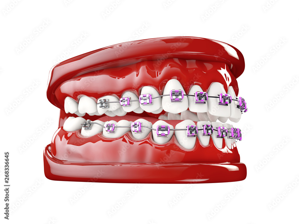 Teeth with brackets, Dental care concept 3d illustration Teeth with brackets, Dental care concept 3d illustration