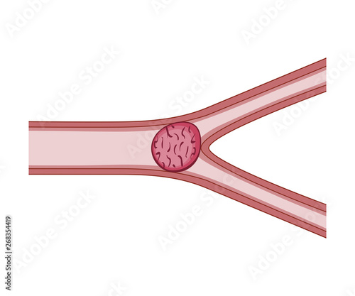 Embolism Blood Vessels