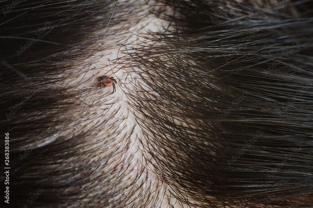 Discover 123+ ticks in human hair latest tnbvietnam.edu.vn