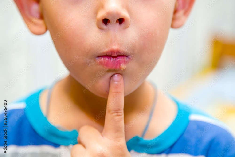the boy points his finger to the pain on the lip the boy points his finger to the pain on the lip