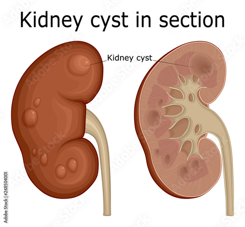 Kidney cyst in section