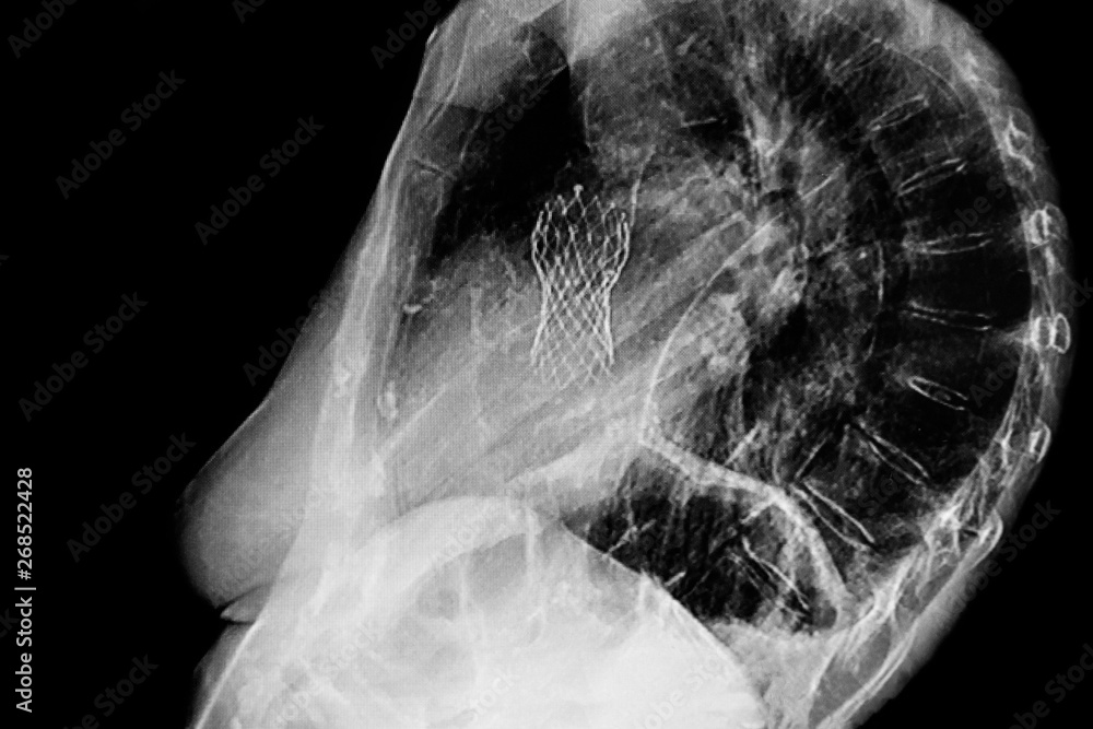 Chest lateral X Ray which shows an aortic valve replacement done