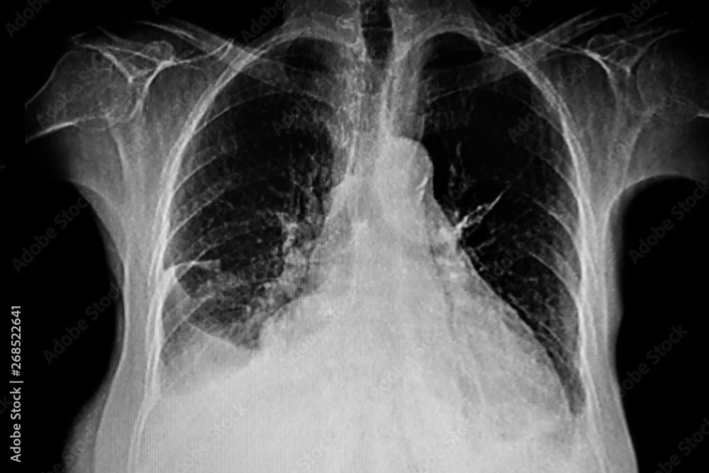 Chest X-Ray of a male patient with right pleural effusion and pneumonia Chest X-Ray of a male patient with right pleural effusion and pneumonia